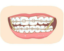 牙齒矯正，塑形正畸，美牙隐形矯正牙套品牌，擁有一口完美的牙齒 